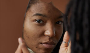 African American woman looking for causes of acne