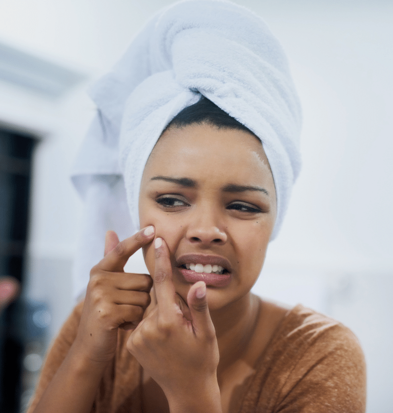 skincare tips for teens: Leave your pimples alone!