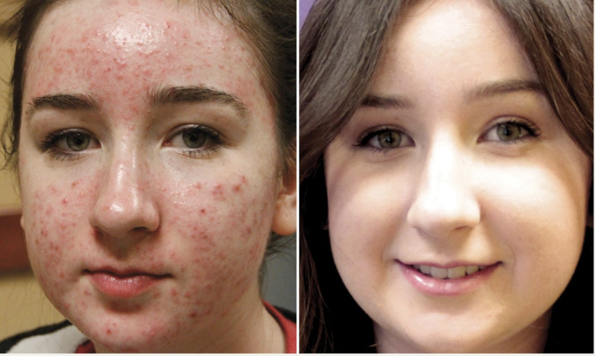 Acne Awareness Month - acne scarring before and after photos