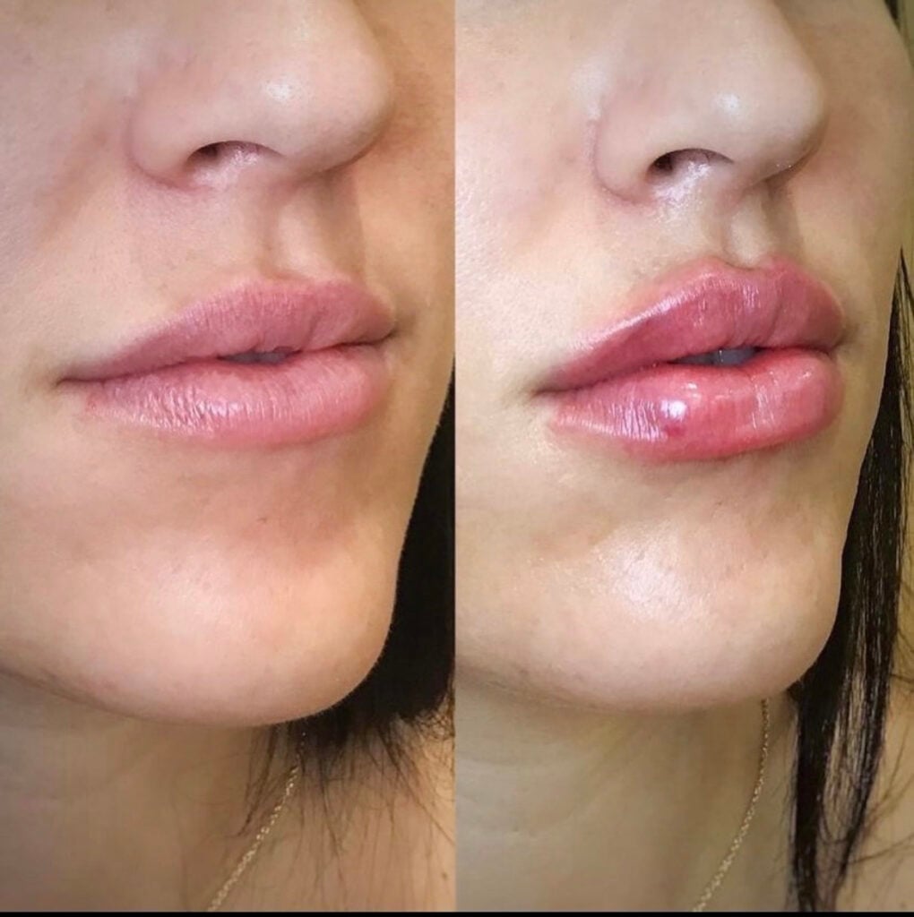 lip filler