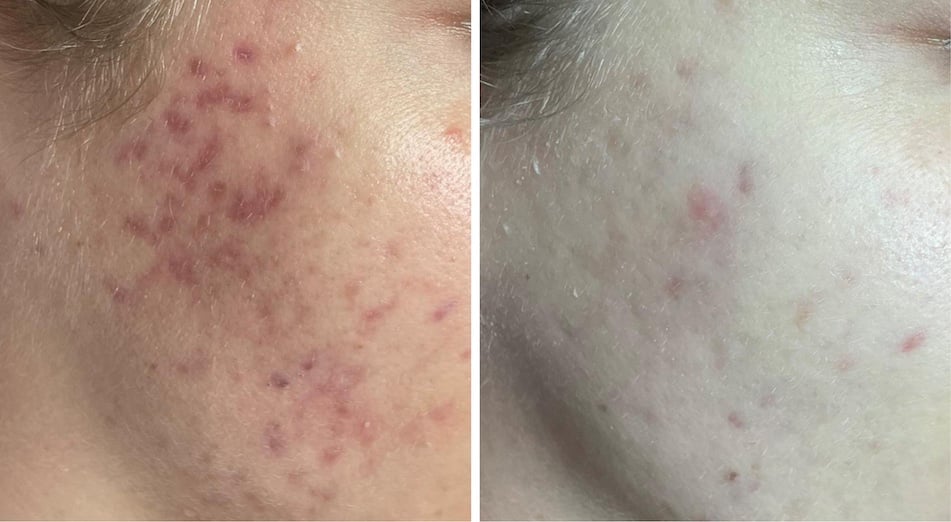 Microneedling Before and After