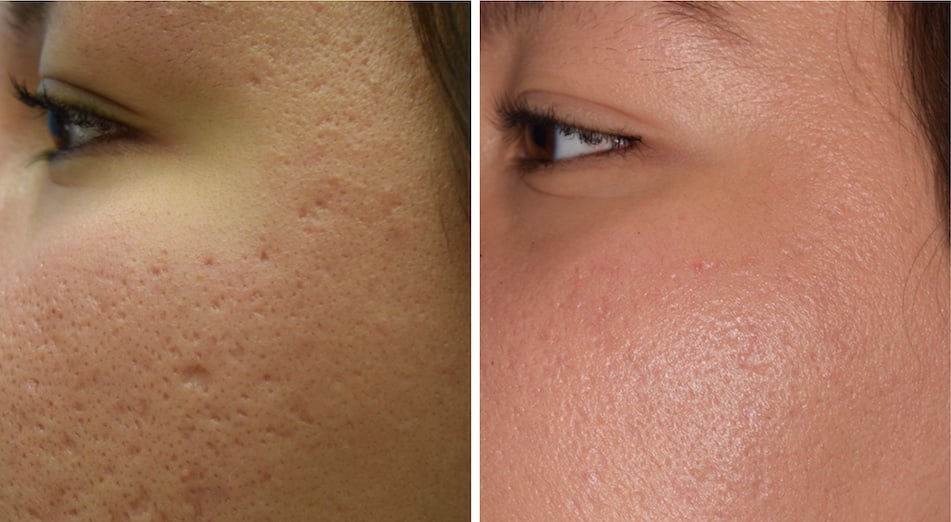 Halo Skin Resurfacing Before and After